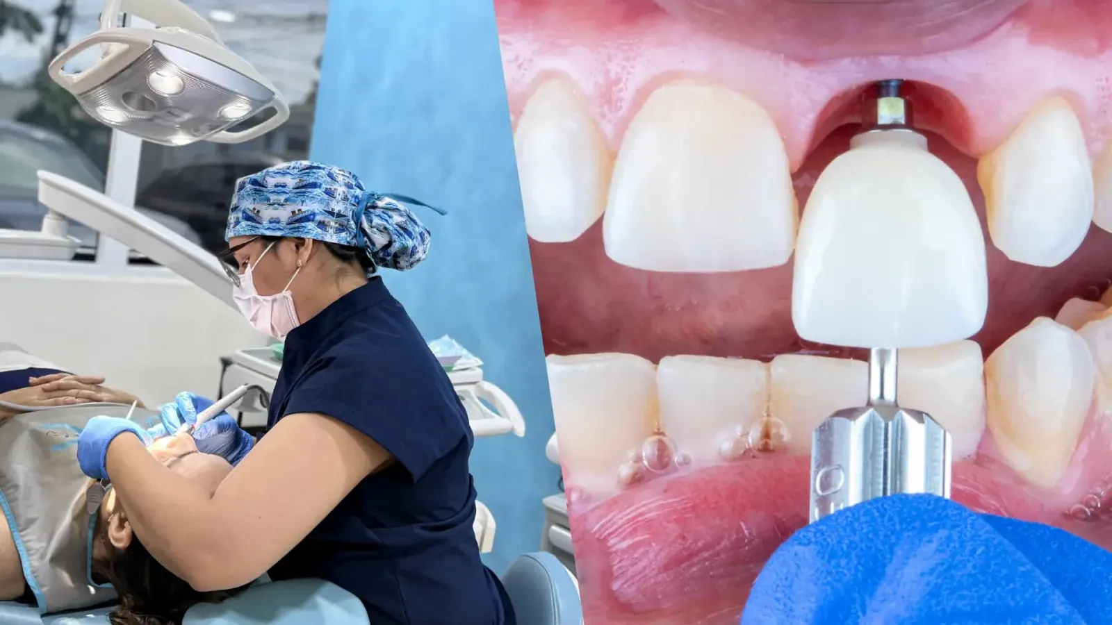 Corona siendo colocada sobre implante dental en boca del paciente