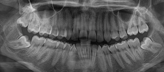 Radiografia panoramica de cordales impactadas