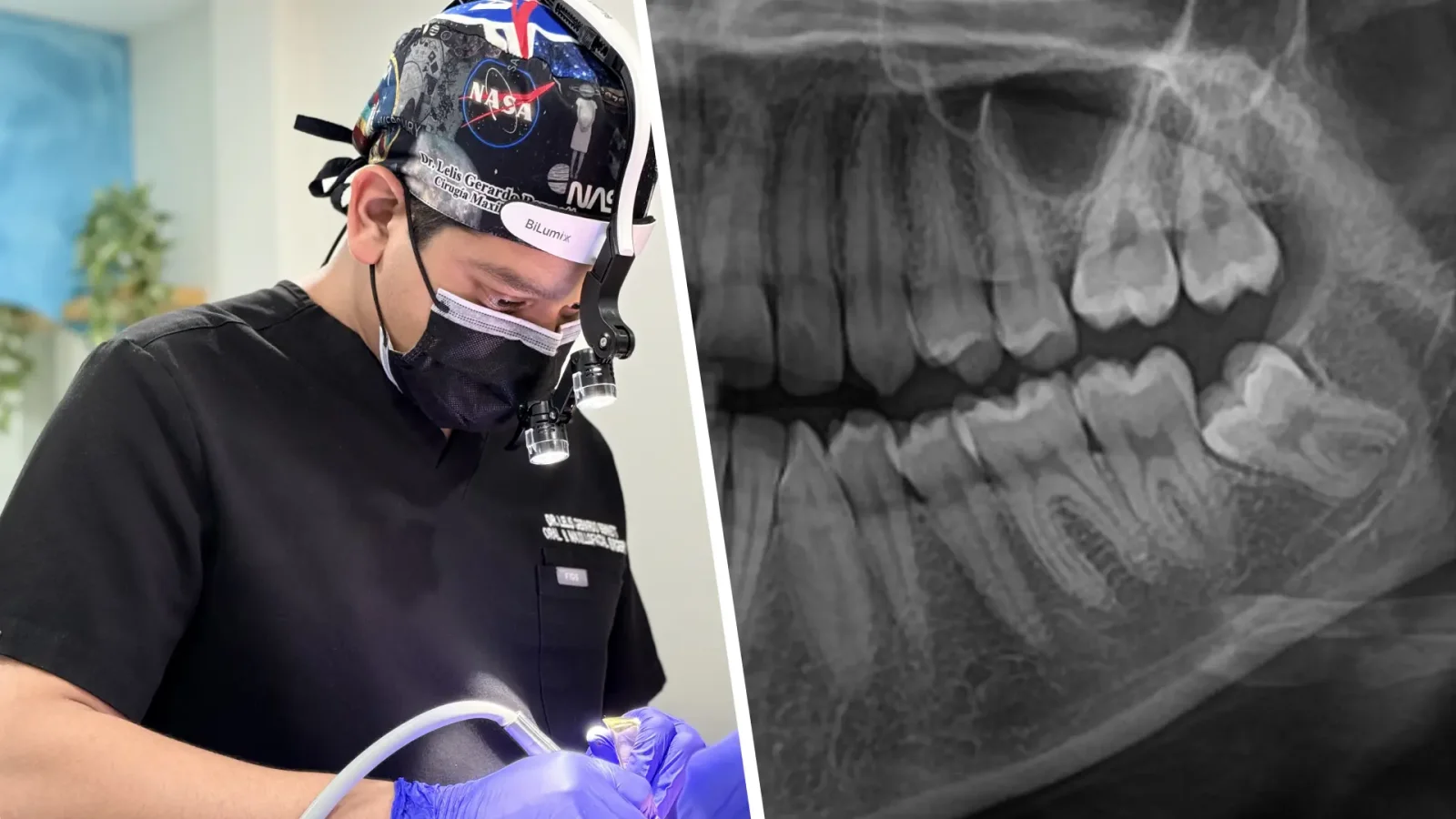 Muela del juicio impactada presionando el molar vecino, con inflamación de la encía