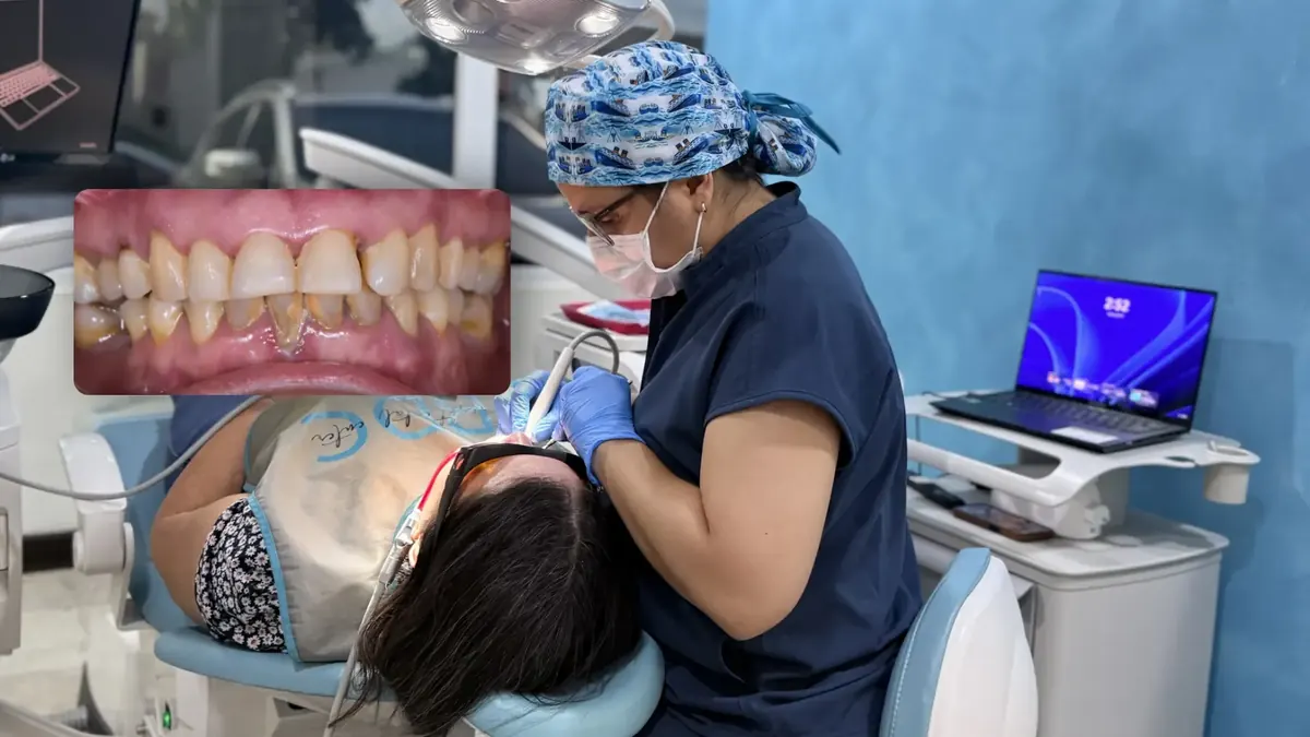 Tratamiento de periodoncia en Bright Dental Center
