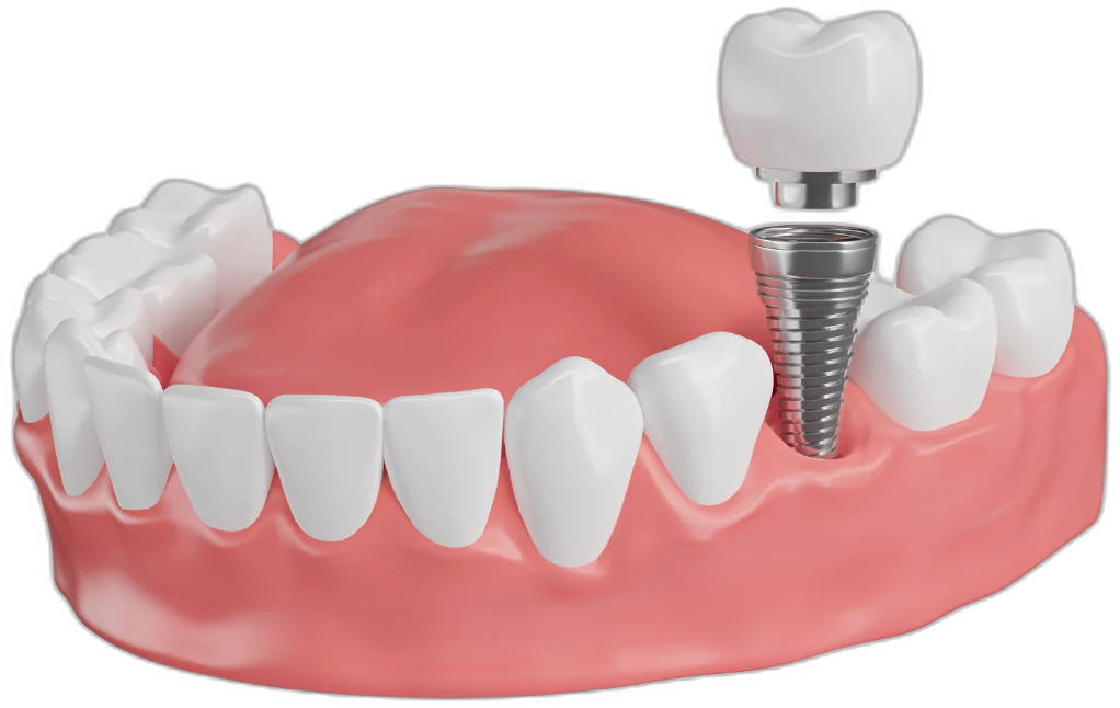 Implante dental colocado por la Dra. Gabriela Cubas en Bright Dental Center San Pedro Sula